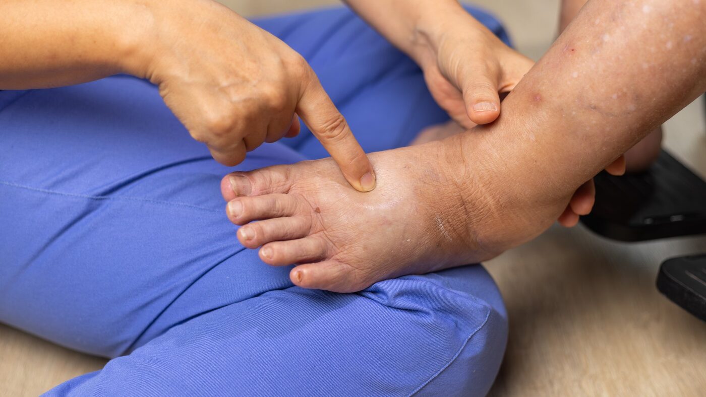 足首のむくみ(浮腫)を指で押して確認している様子