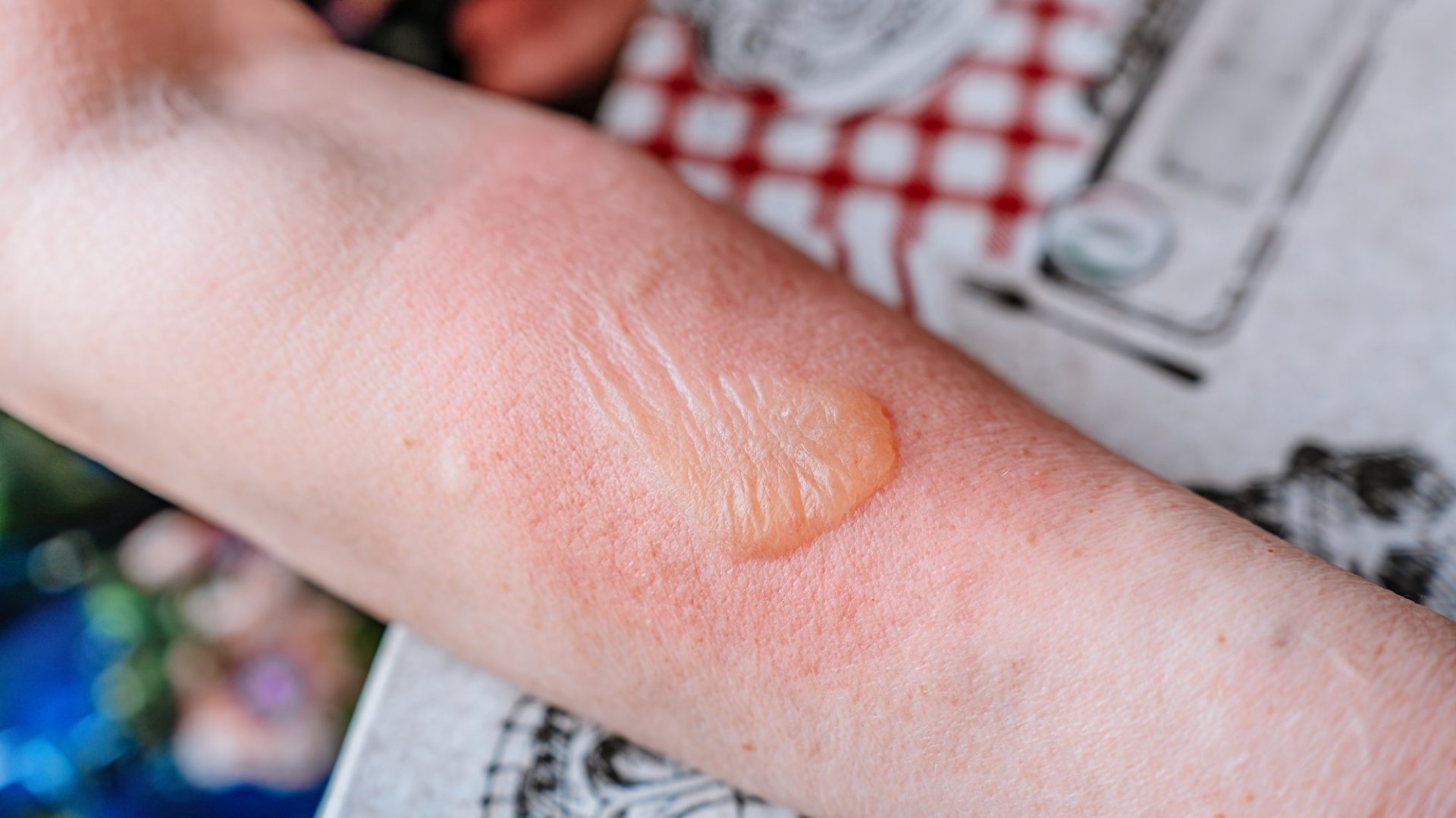 やけどで水ぶくれができた前腕