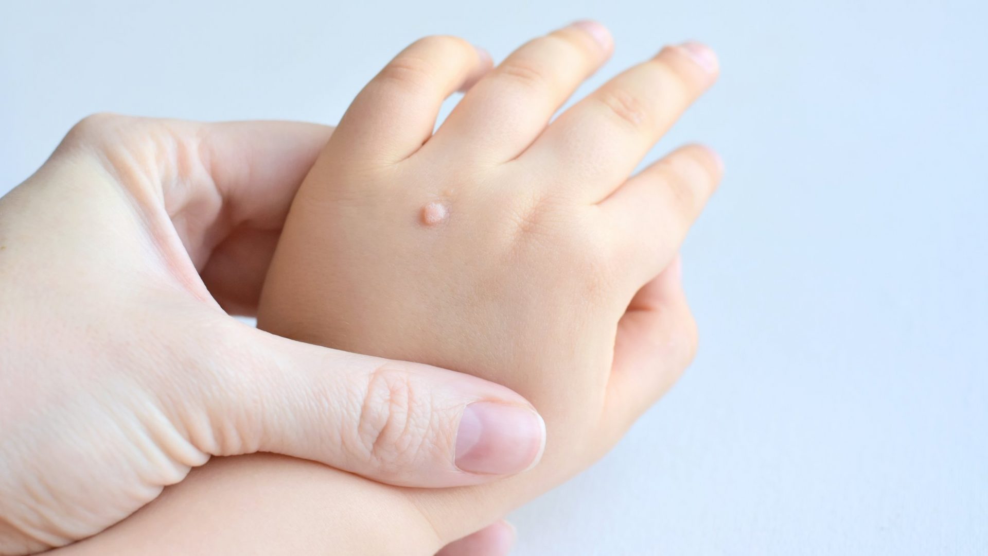 子どもの手にできたウイルス性いぼ